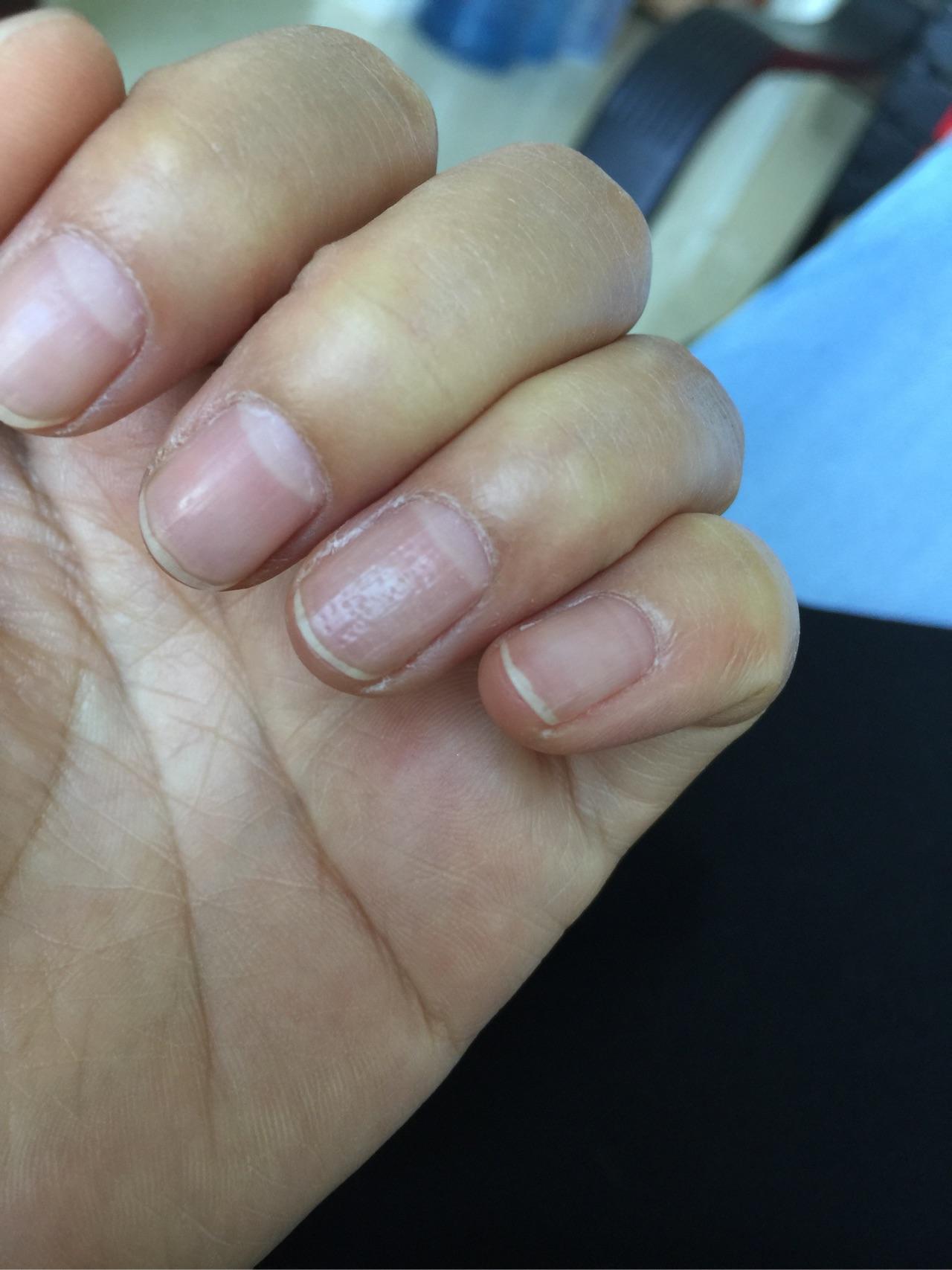 我的指甲上有很多小坑,好几年了,怎么回事? - 知乎