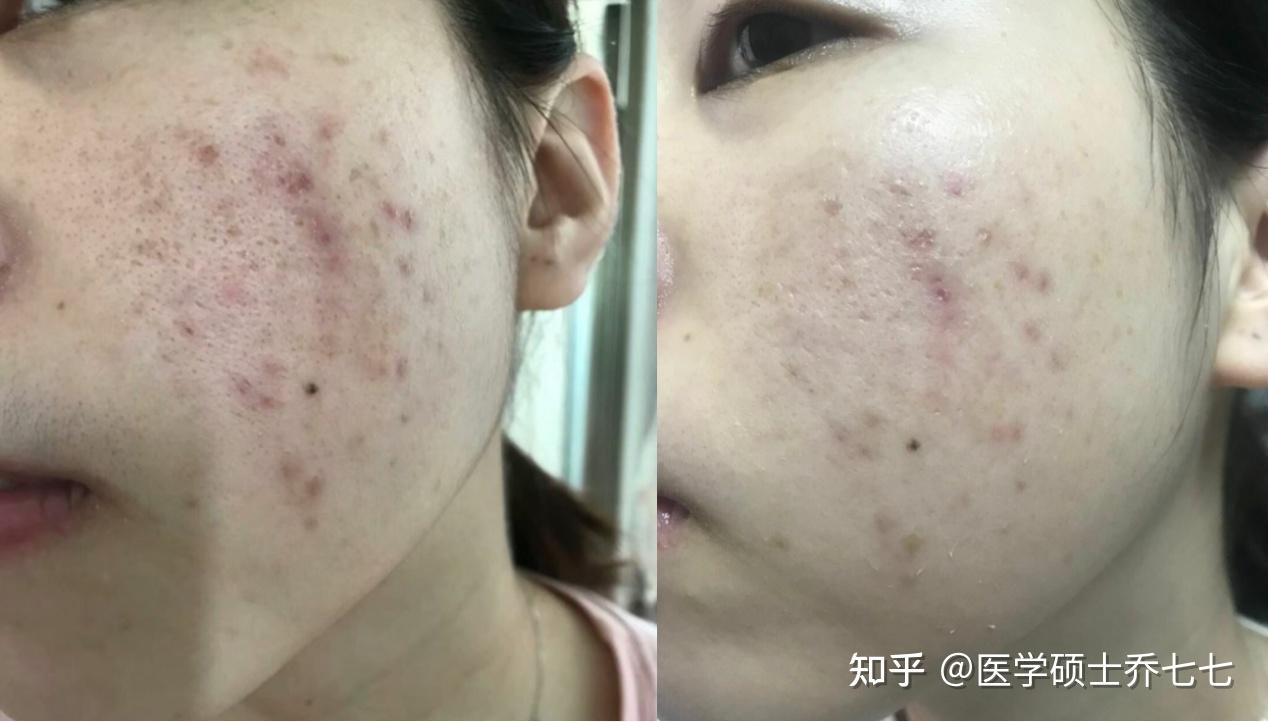 新手刷酸必看:超全刷酸教程!这两个刷酸步骤大多数新手都会忽略!!医学硕士教你如何正确刷酸!!