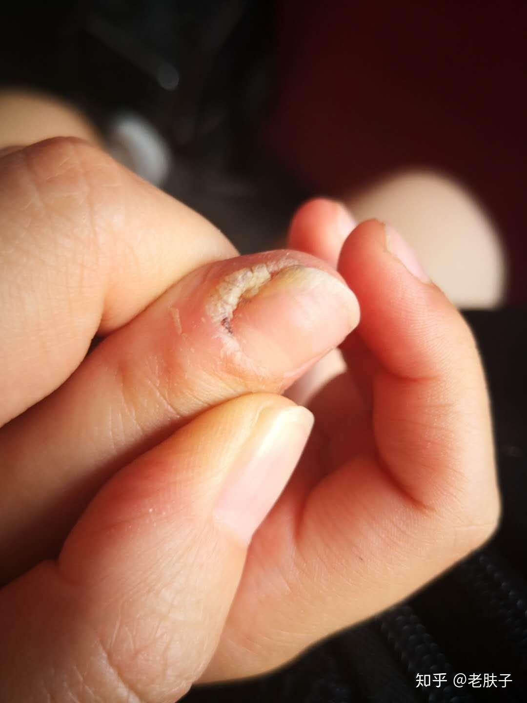 甲周疣怎么办 - 知乎