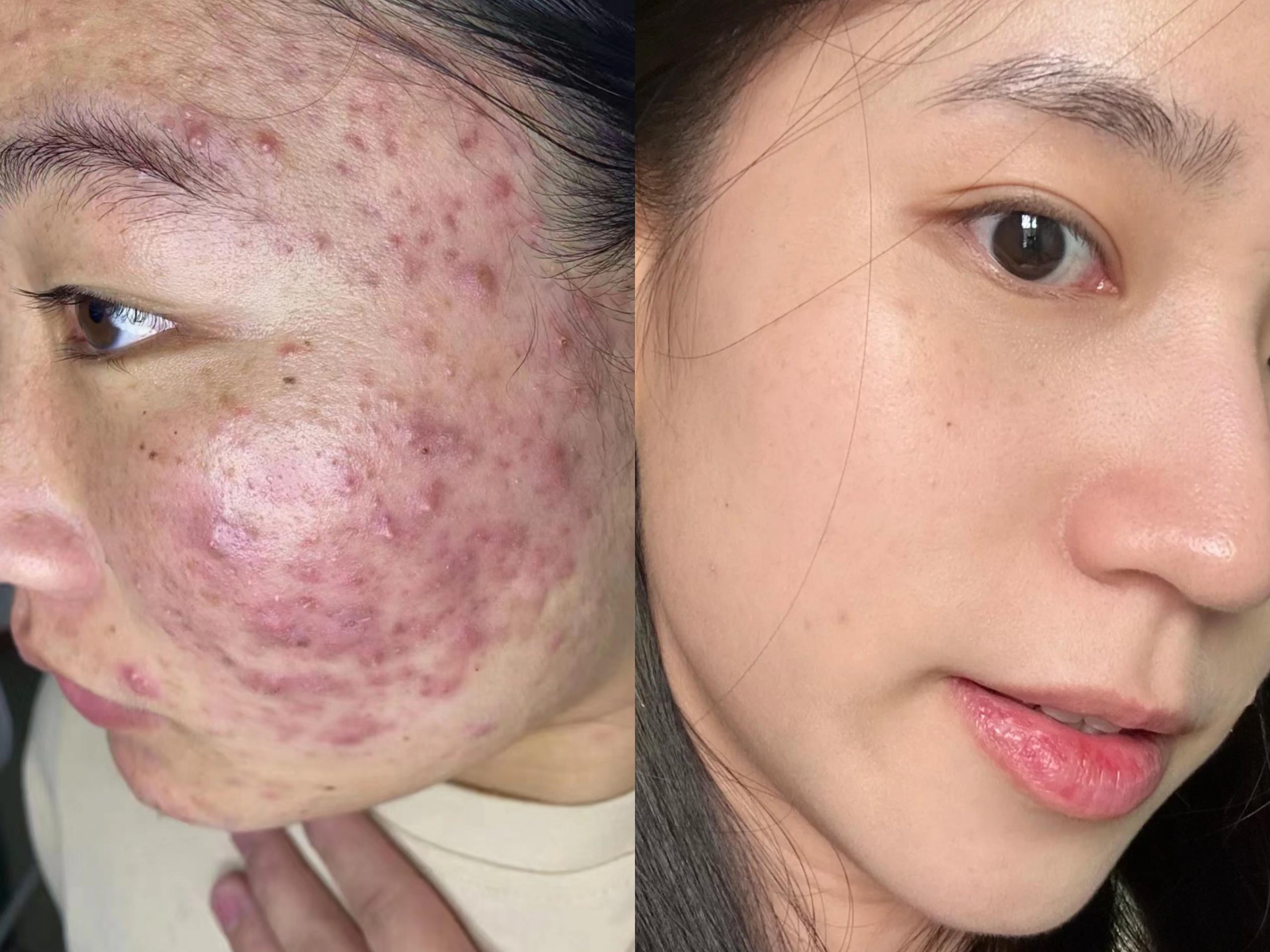 有什么办法有效去除出脸上的痘痘和痘印