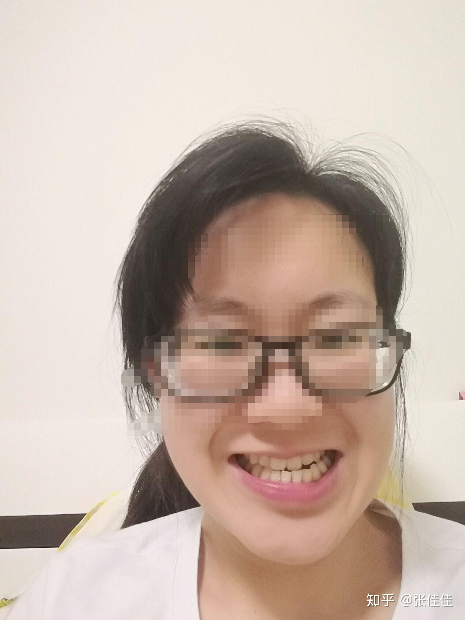 儿童反颌矫正后在换牙期会反弹吗? - 知乎