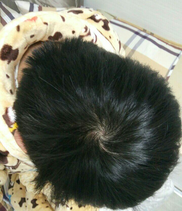 请问我这算几级脱发 有救吗?