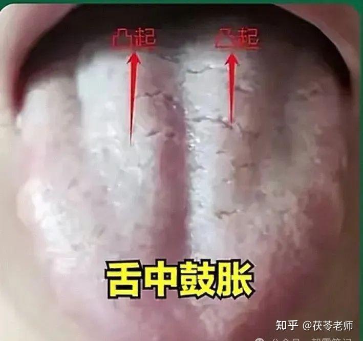 肝郁:舌中鼓胀用逍遥丸,舌边鼓胀用柴胡疏肝丸 ,有瘀斑瘀点用越鞠丸 - 知乎