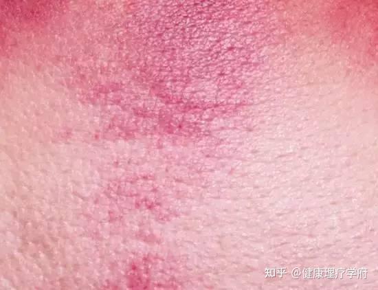 学习无痛刮痧，附痧象图解！ - 知乎