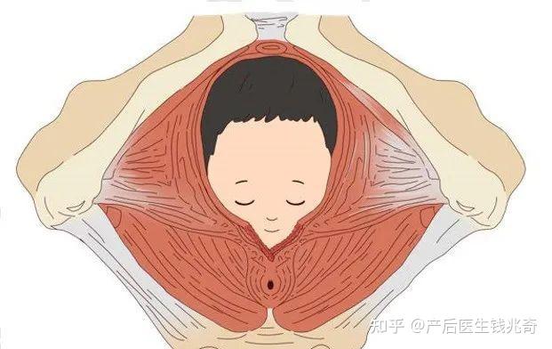 拿阴道分娩来说,阴道分娩引起的损伤主要发生在第二产程,这时胎头对