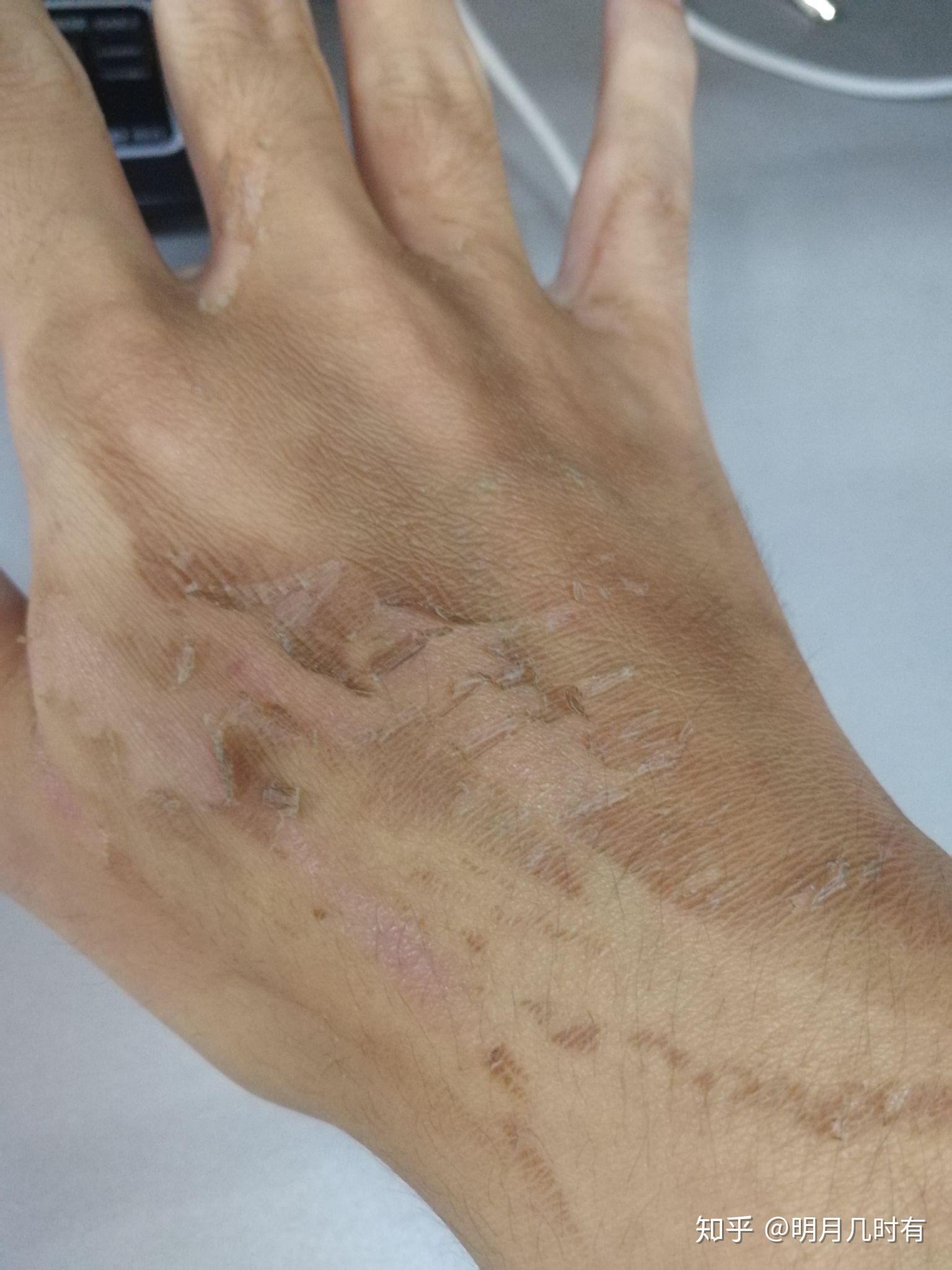 手烫伤了怎么处理?