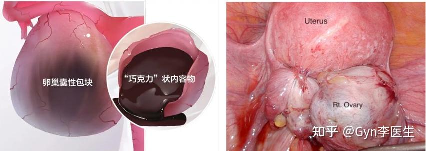 卵巢巧克力囊肿 症状图片