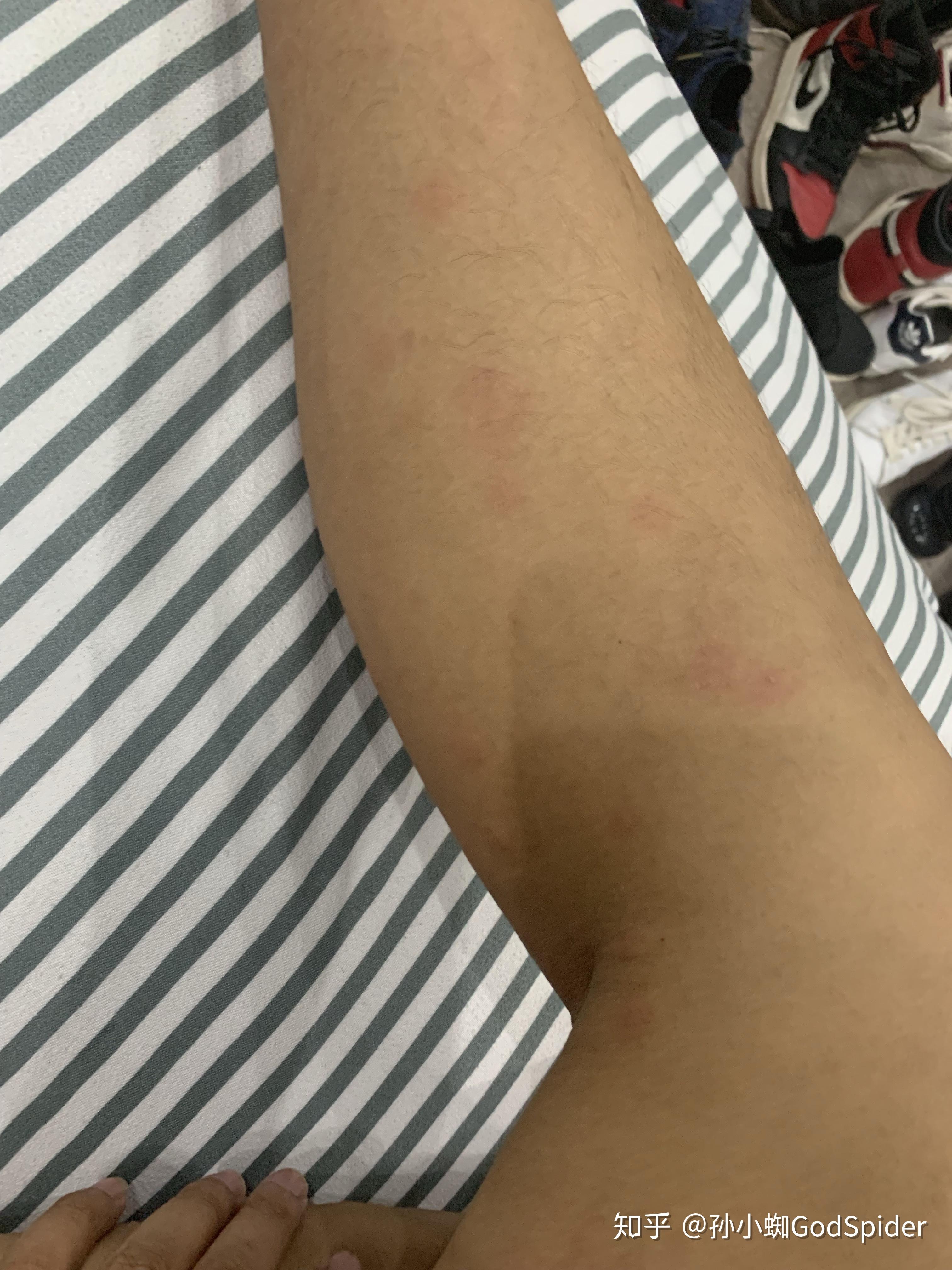 这两天身上会莫名其妙的起小包,就跟蚊子咬的那样痒,床单被罩也都换了