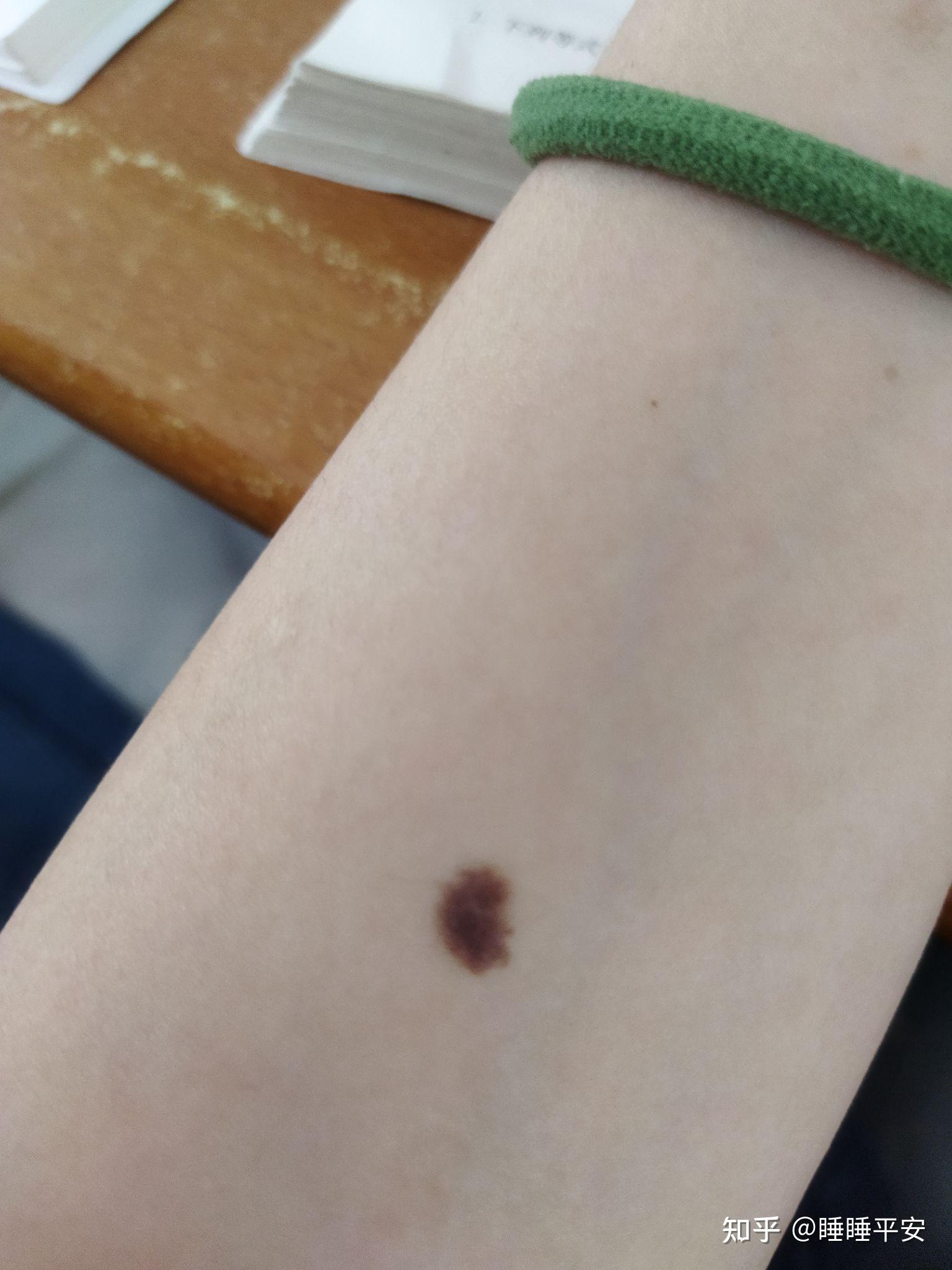 身边不少人手腕或手臂中央都有一颗痣不知道是概率事件还是什么玄学你