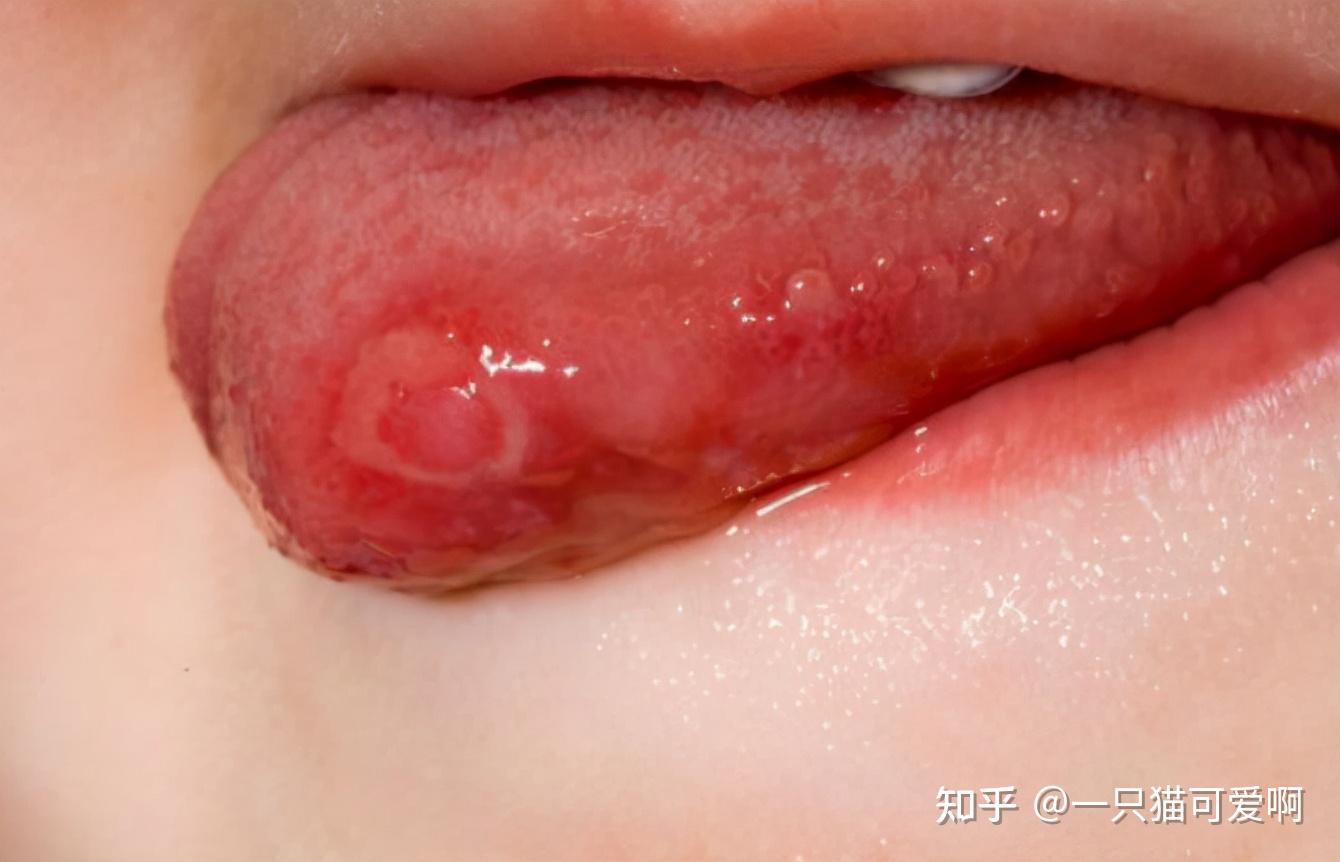26岁女子舌头溃疡,查出hpv感染,医生呵斥:交友不慎 