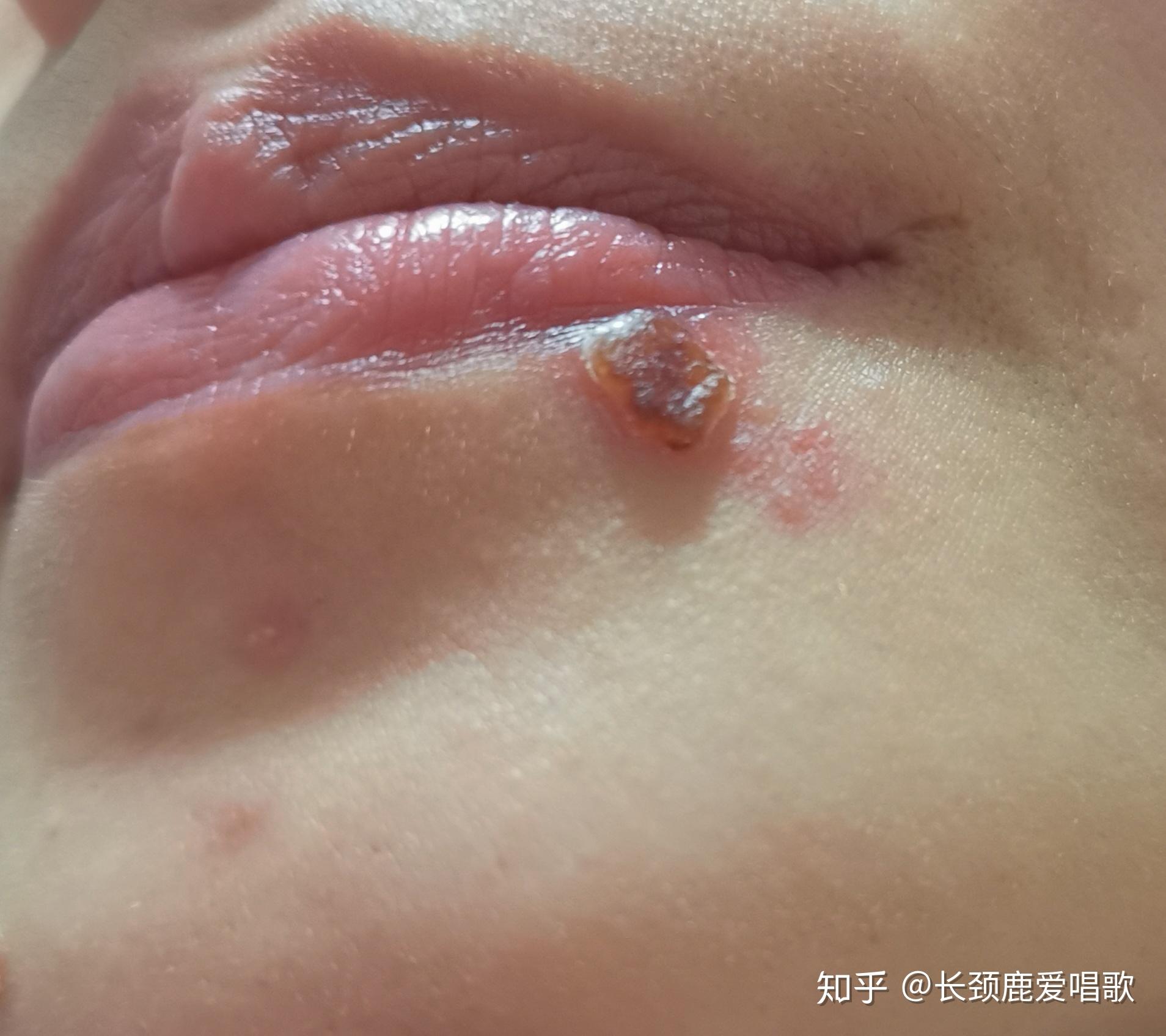 口唇疱疹怎么能快速好啊?急~? - 知乎