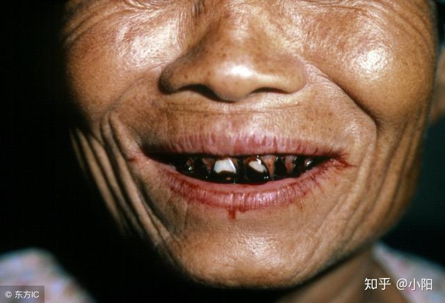 槟榔成瘾者自述为了戒槟榔把最恶心的口腔癌图片当桌面
