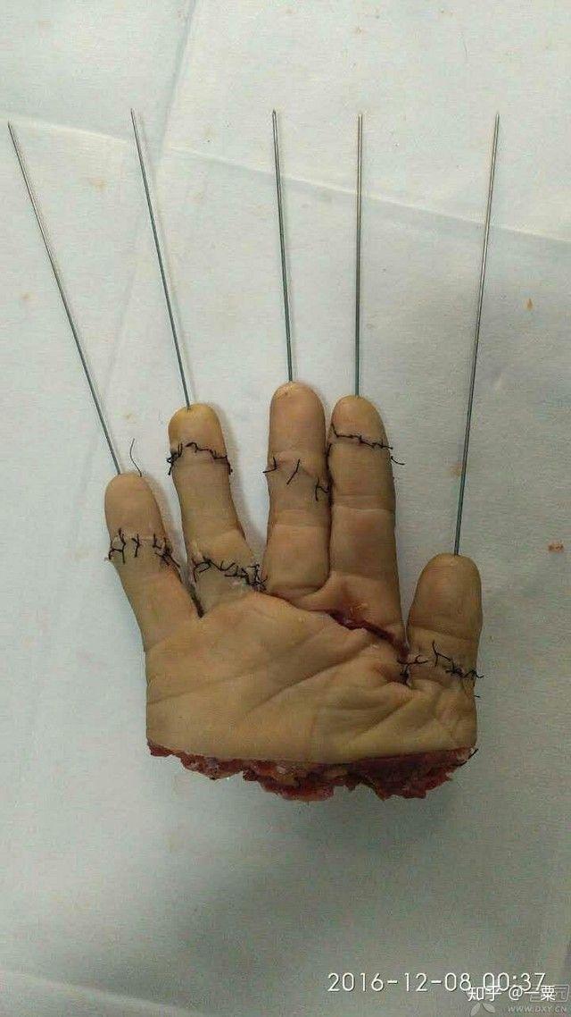 奇异博士的手神经断裂在现实世界中能治好吗