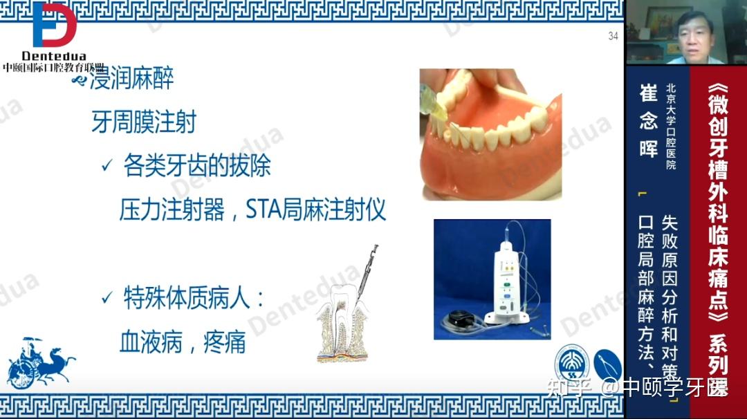 牙周膜注射法图片