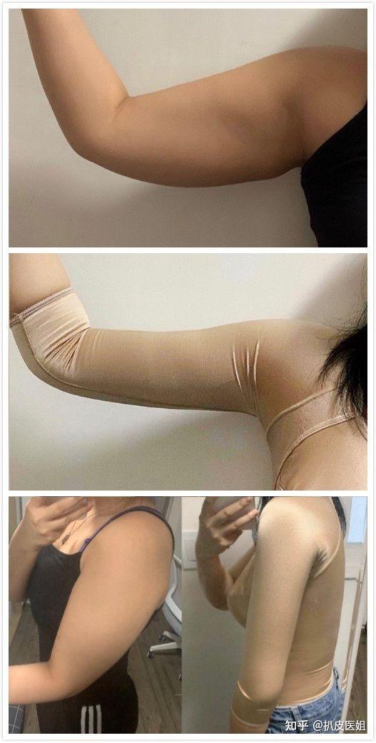 吸脂擅长手臂以及大腿,对于面部脂肪填充也是擅长.