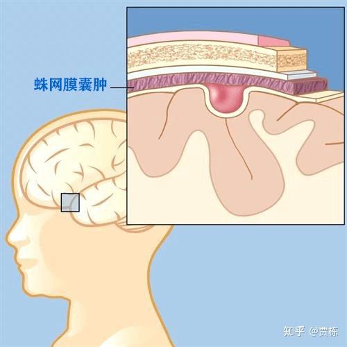 枕大池囊肿位置图图片