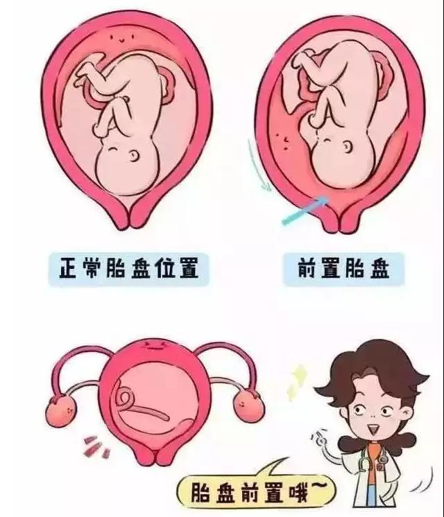 中期 出血 妊娠