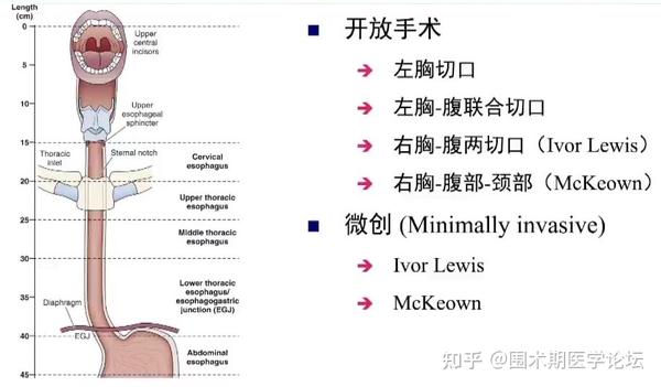 Eras专栏丨薛张纲教授：食管癌根治术的麻醉管理——eras临床实践 知乎