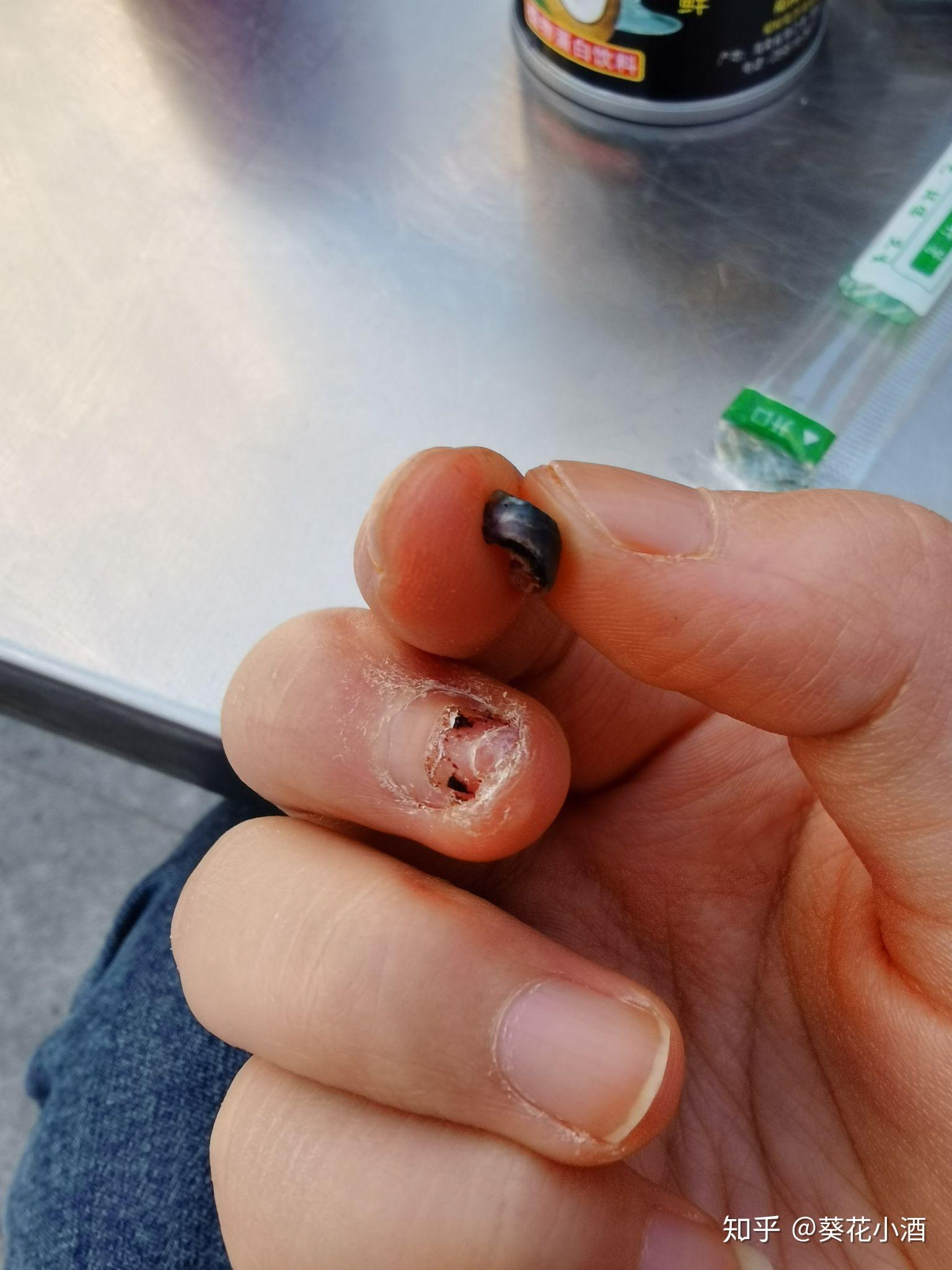 手指被门夹肿还夹出淤血是什么感受? - 知乎