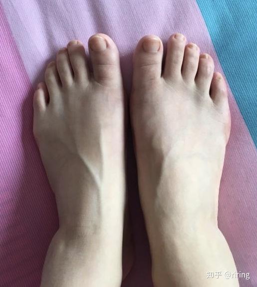 拇外翻微创手术是未来的趋势or一个商业骗局 知乎