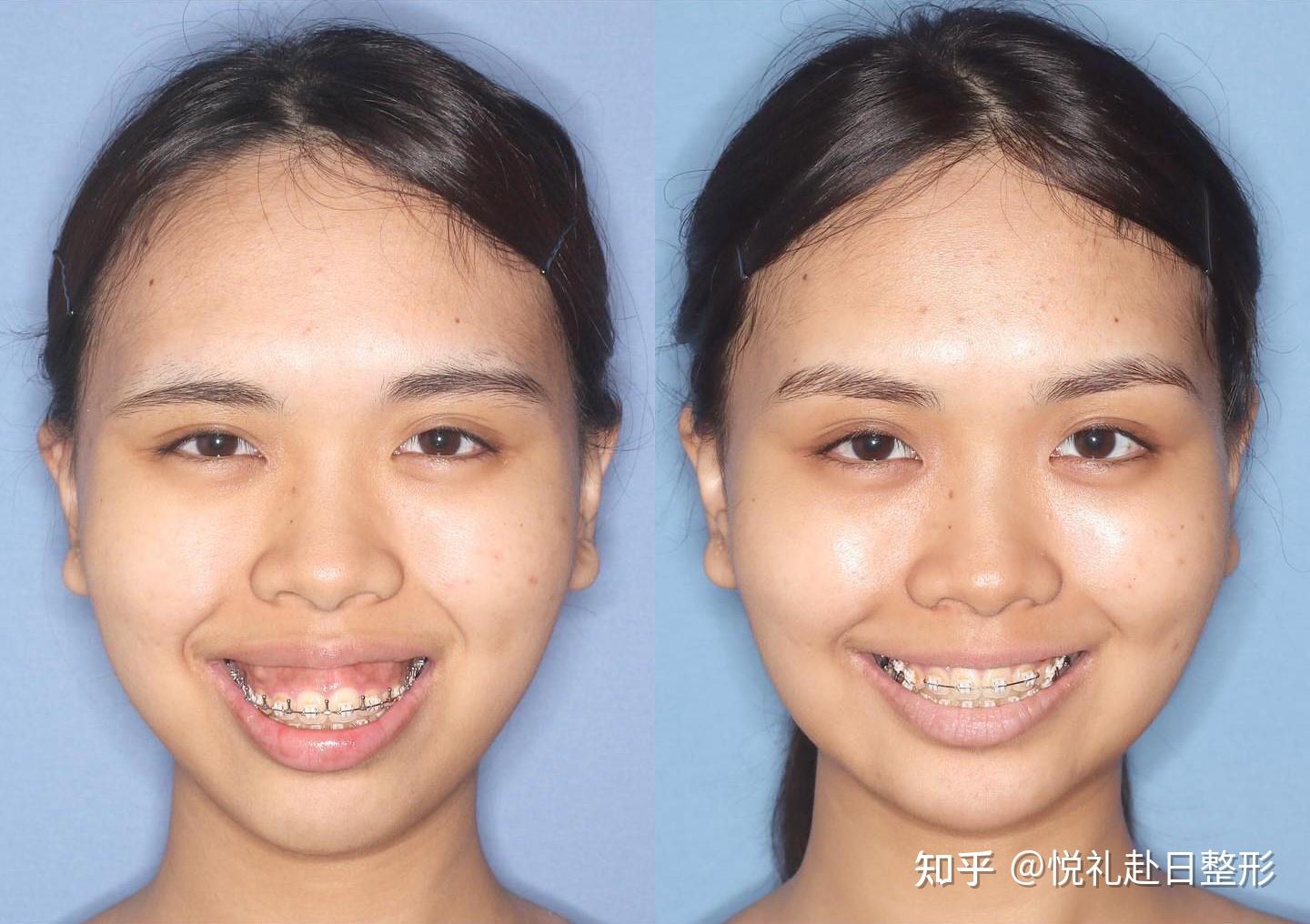 广比利次 | 双颌手术 颏成形 - 知乎