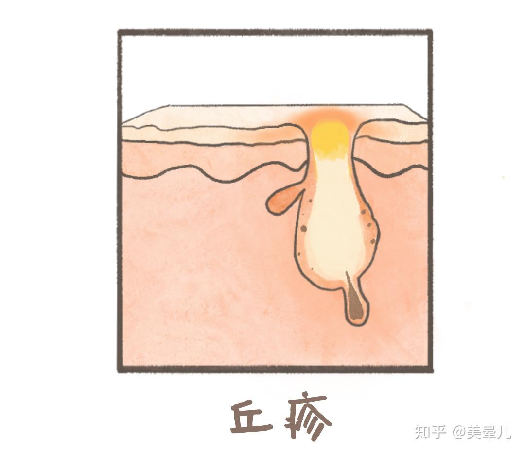 61 主要分為三度4級 61輕度Ⅰ級:粉刺 (黑頭,白頭粉刺,閉合性粉刺