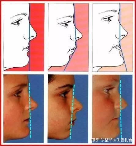 凹面型脸想整成二次元风格应该关注什么