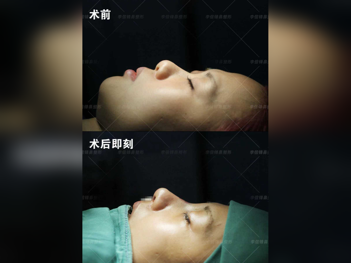 初鼻鼻综合-短塌鼻、漏鼻孔,面中部凹陷改善案例,术后即刻对比~ - 知乎