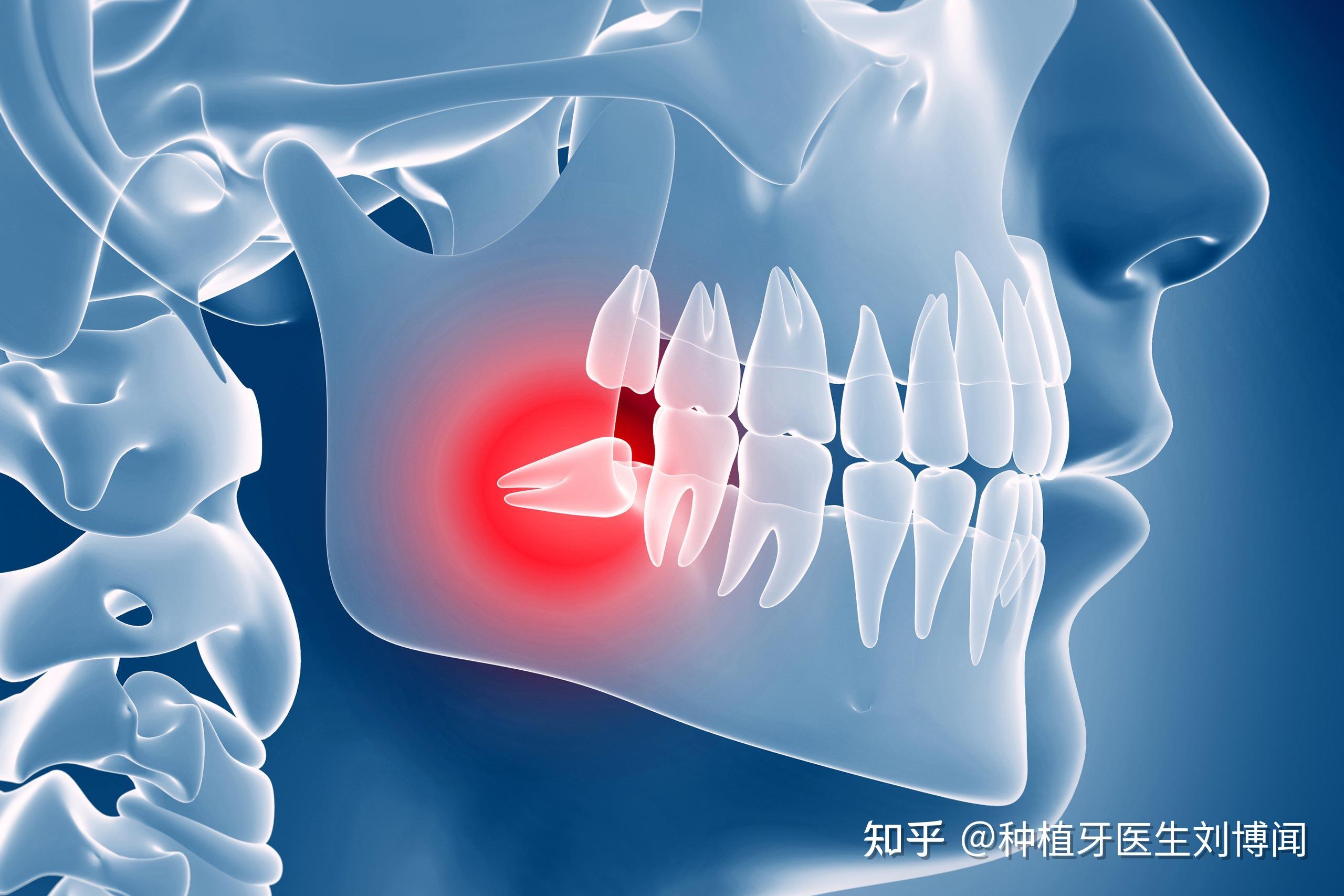 拔智齿有多痛? 