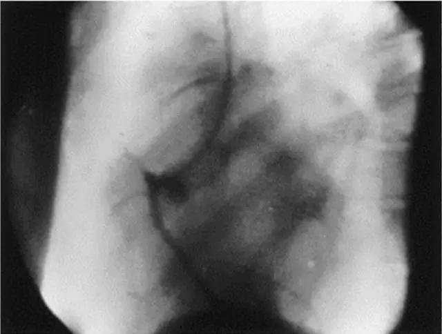 什么是动脉血管造影 v2-5587b4de04837dac4c2df07ffef3bac9_1440w.jpg?source=172ae18b