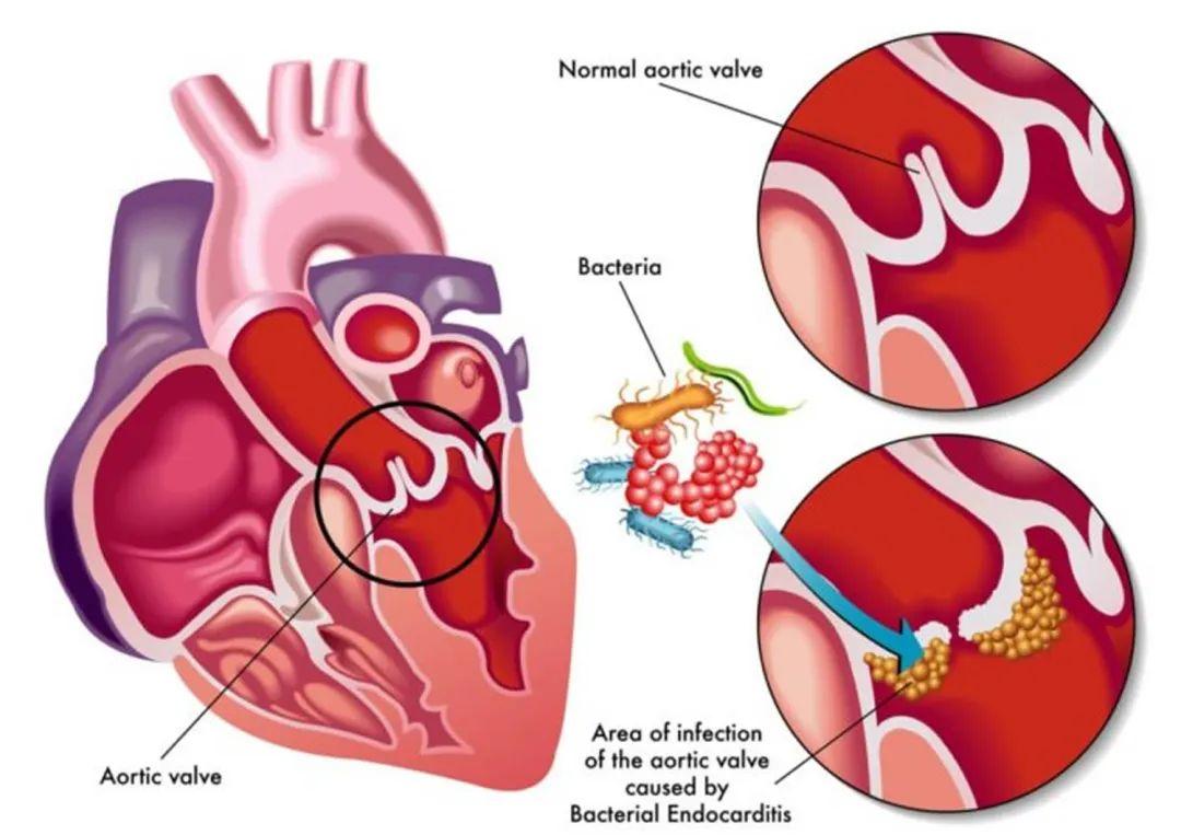 endocarditis,ie) 系指病原微生物迁徙至心脏瓣膜和(或)心内膜,以及