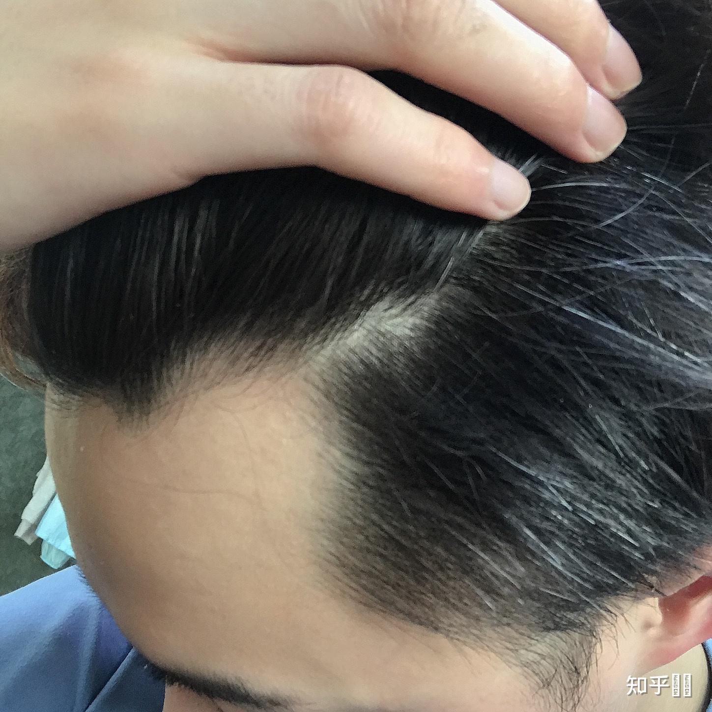 男生发际线高是一种什么样的体验? - 知乎