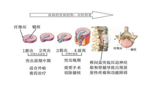 卧床休息与运动锻炼对于腰椎间盘突出都不可缺 知乎