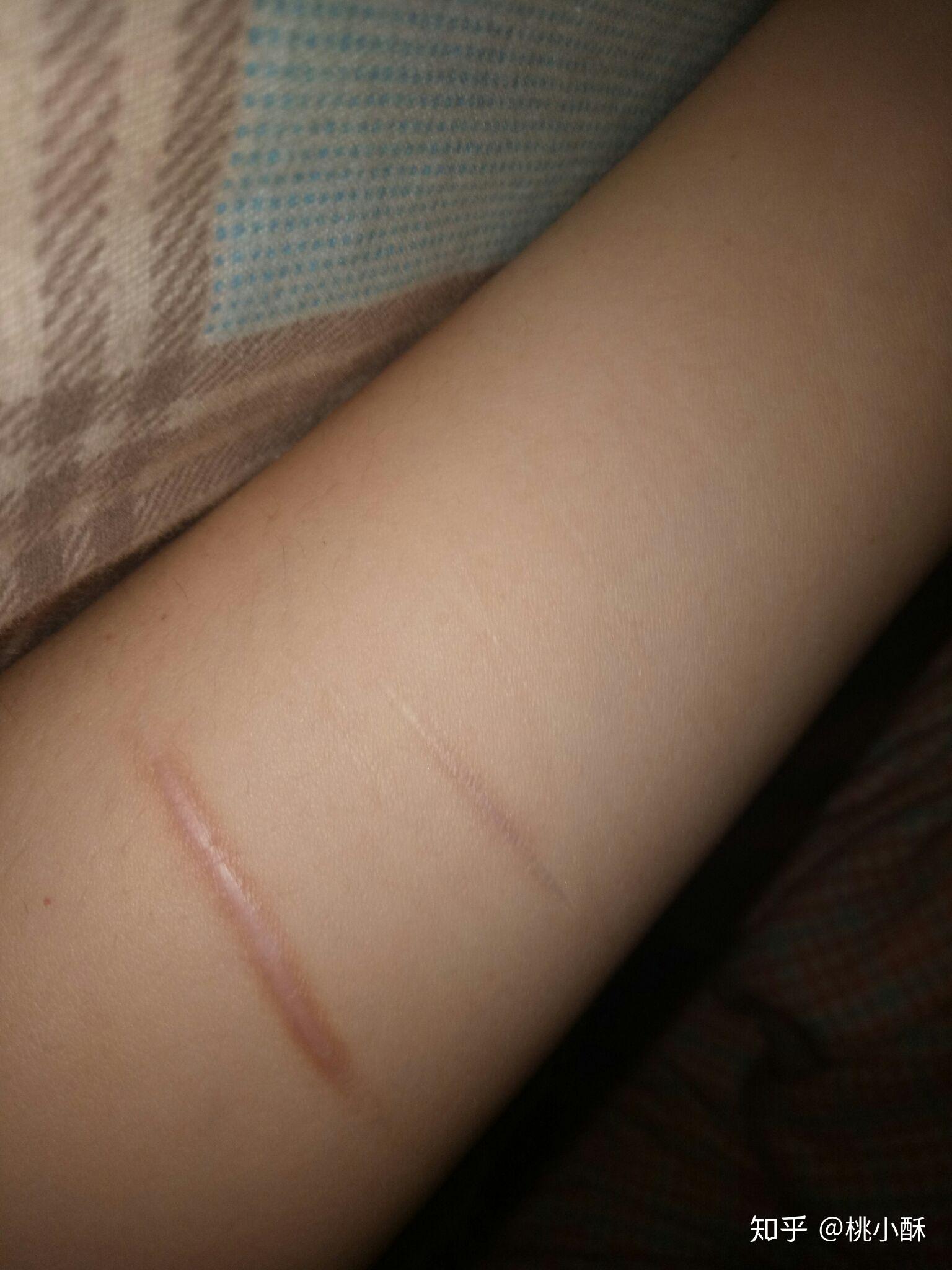 抑郁症患者自残是变态的行为吗