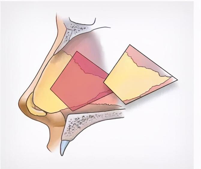 耳軟骨肋軟骨鼻中隔軟骨到底有什麼區別