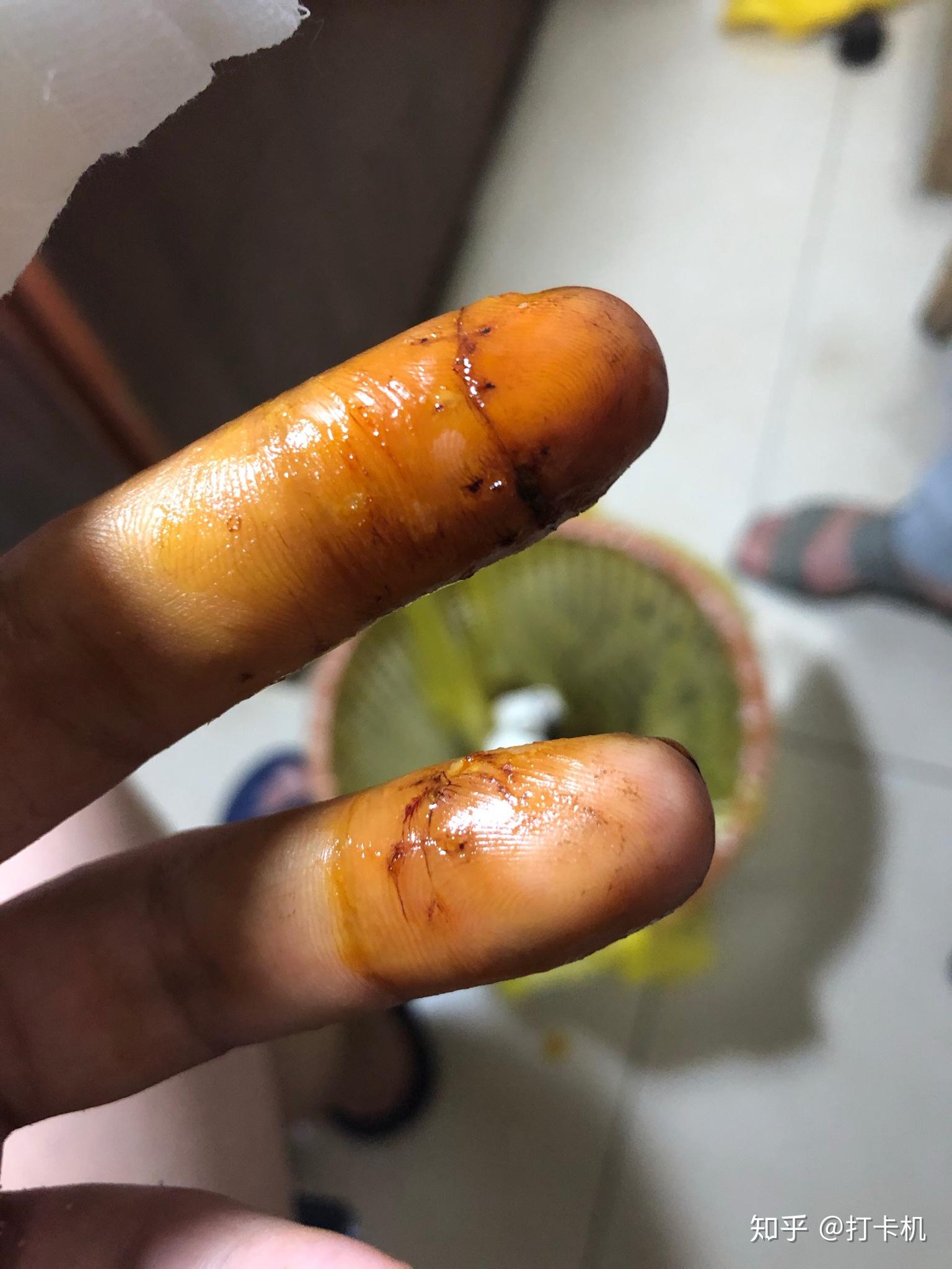 切菜切到手该怎么办? - 知乎
