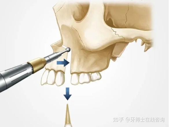 正颌正畸手术的风险大么? - 知乎