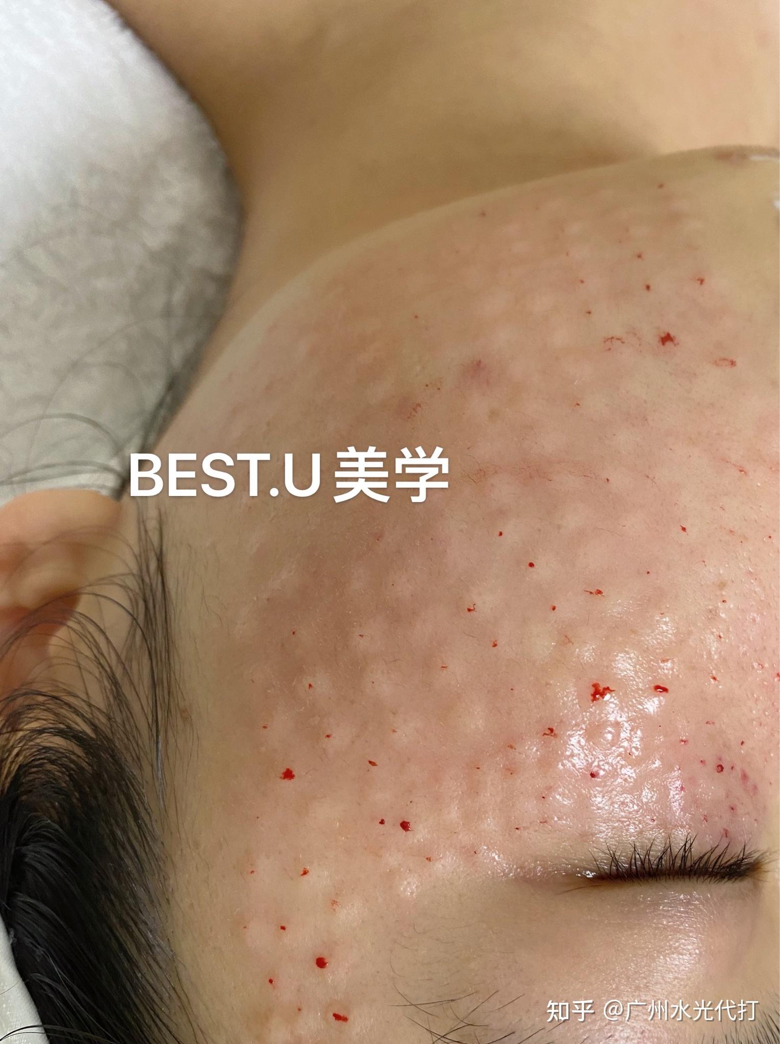 水光皮丘错误打法,不要打的皮肤越来越差 - 知乎