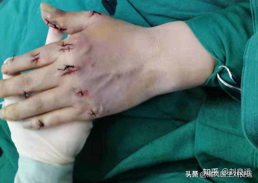 长出痛风石不要紧,手术切除就可以?医生问,您降尿酸了吗?