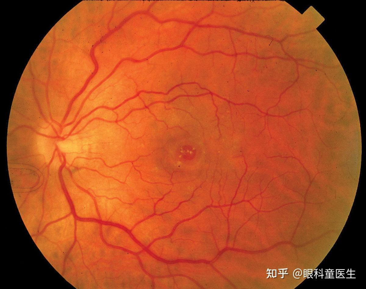 American Journal of Ophthalmology:揭示超大直径黄斑裂孔内界膜填塞术后裂孔愈合规律 - 医疗健康专区 - 生物谷