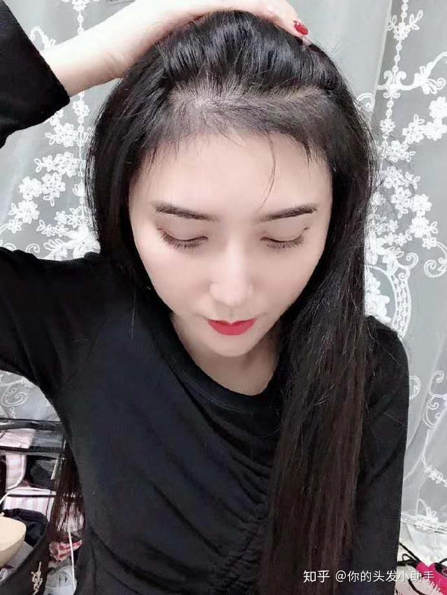 女生发际线高真的没办法吗哈尔滨大麦发际线植发有用吗
