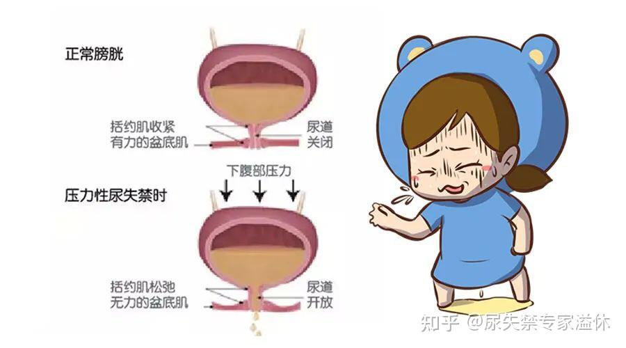 压力性尿失禁PPT图片