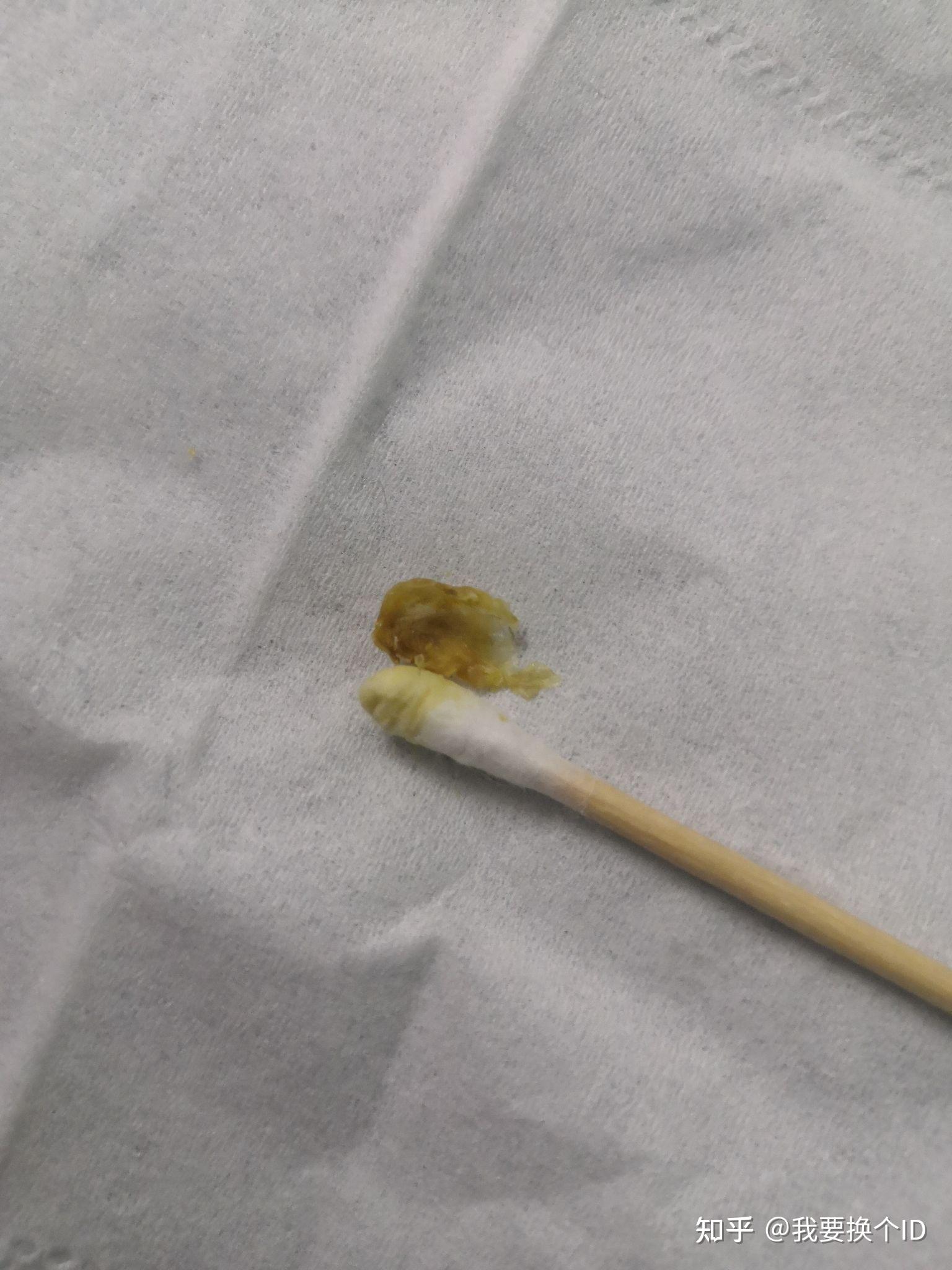 为什么我从来没掏出来过大号的耳耵聍? - 知乎