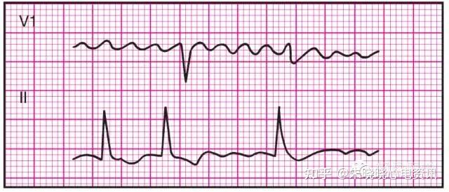 心電基礎ii常見心電圖圖譜解析參考