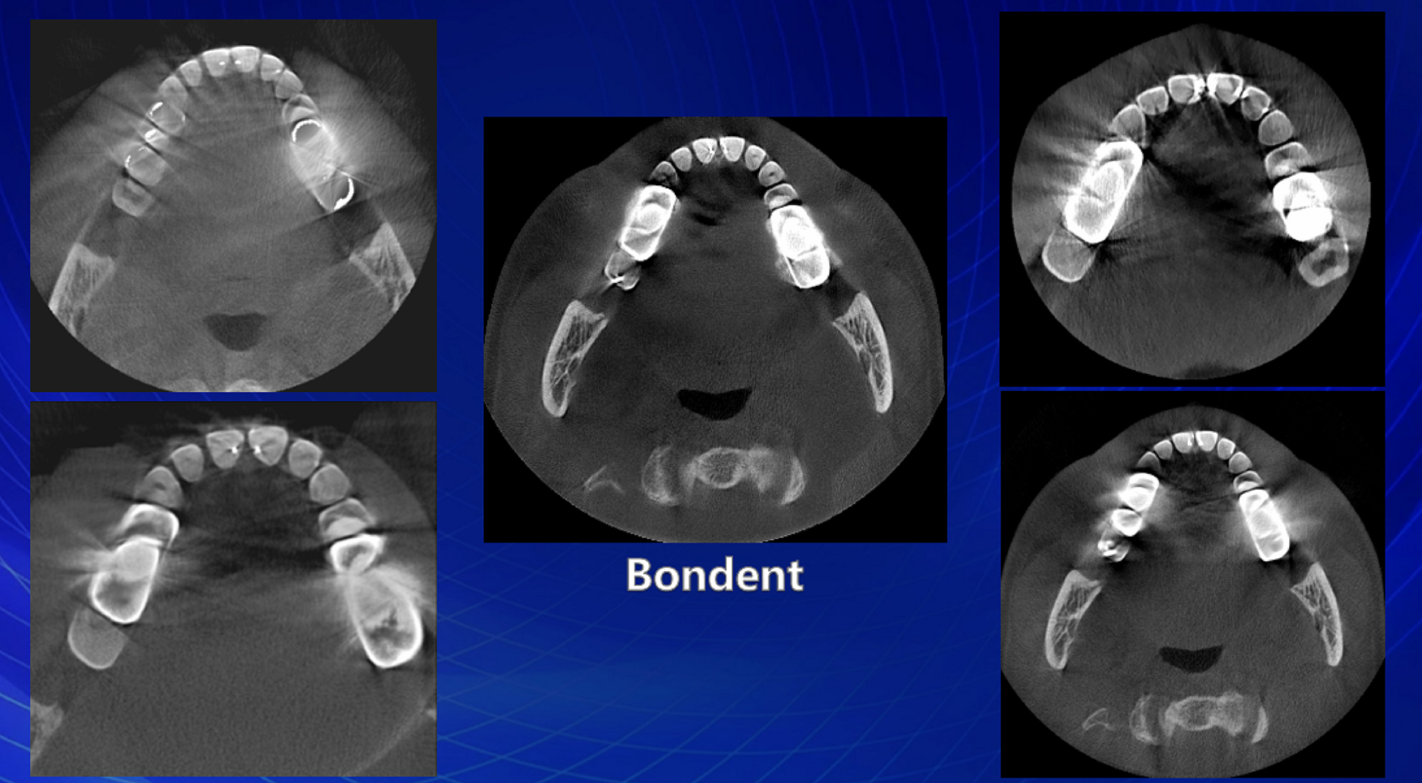 伯爵cbct影像篇⑩新春巨献伯爵口腔ct