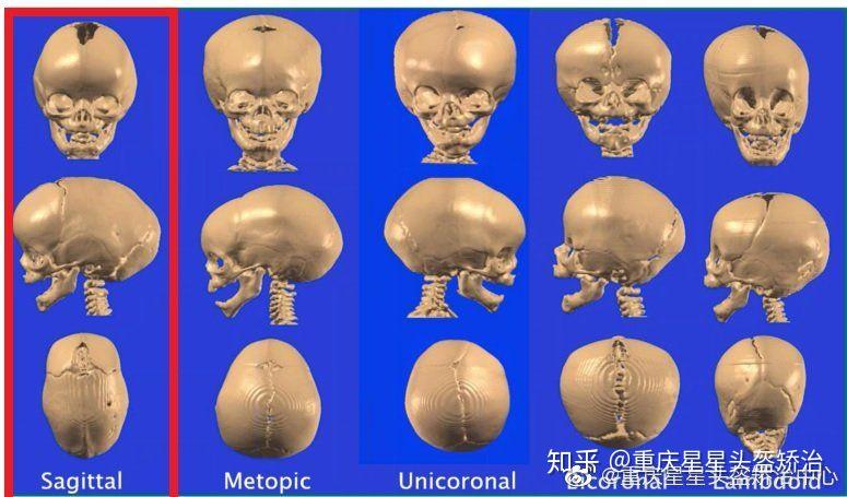 颅缝早闭之失状缝早闭