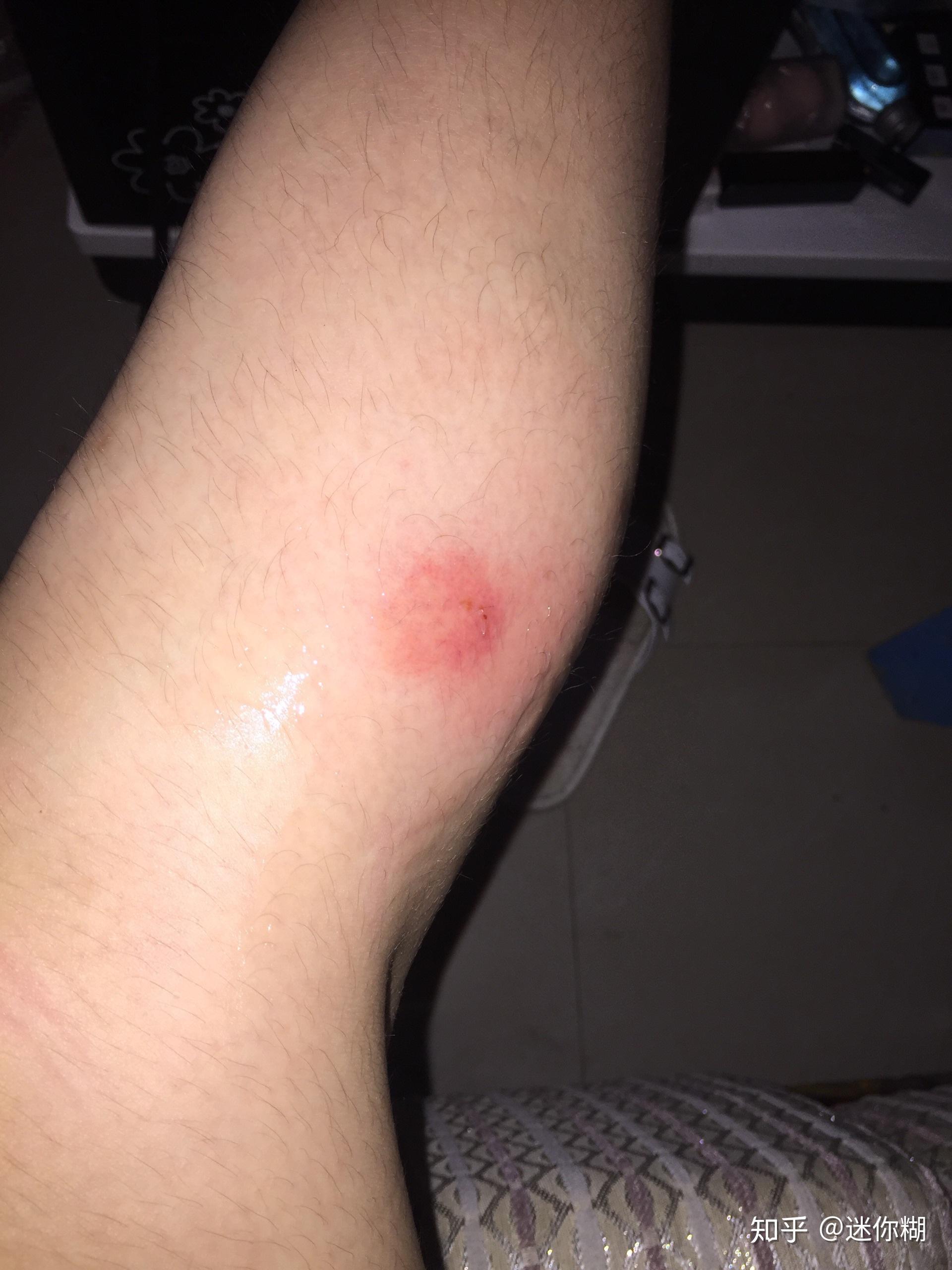 被毒蚊子咬了怎么办