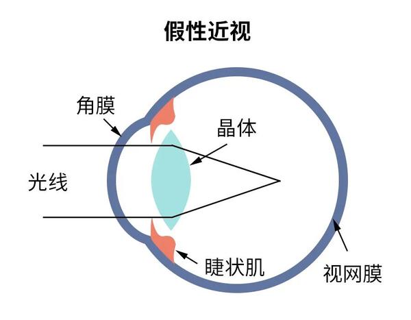 家长最关心的“散瞳验光”那些事，一次给您讲清楚！ - 知乎