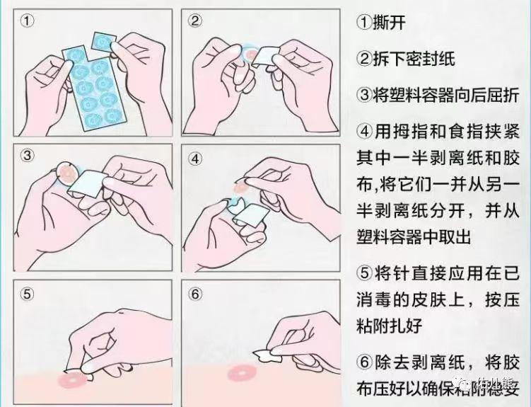 新型中医揿针(皮内针)疗法的操作步骤 - 知乎