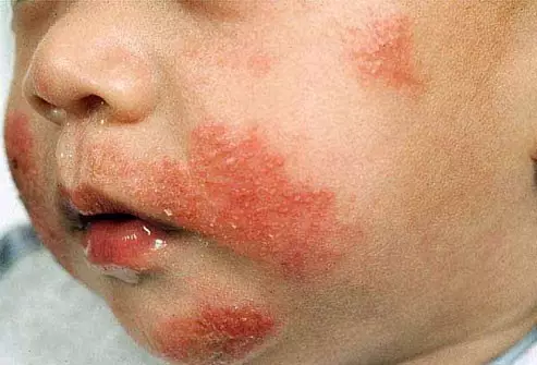 婴儿病毒性湿疹图片